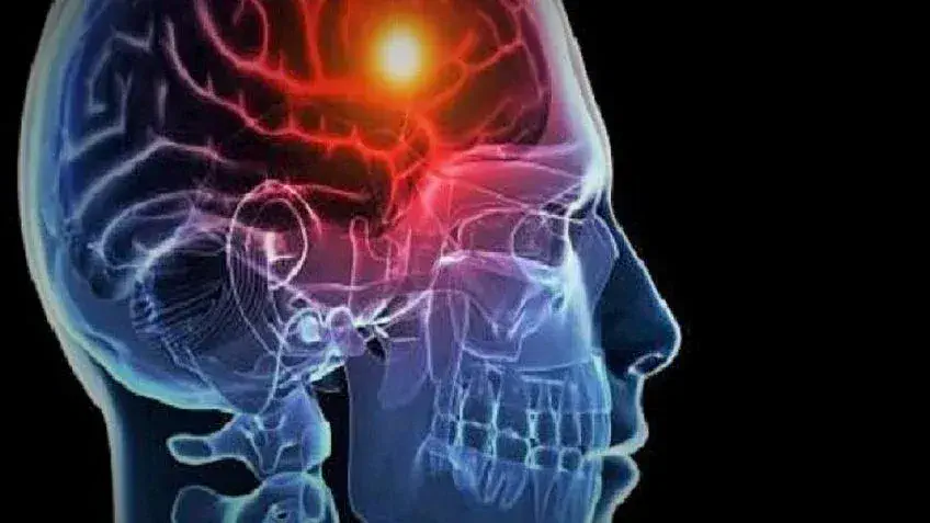 Accidente cerebrovascular en Argentina: 120 mil casos al año que pueden prevenirse