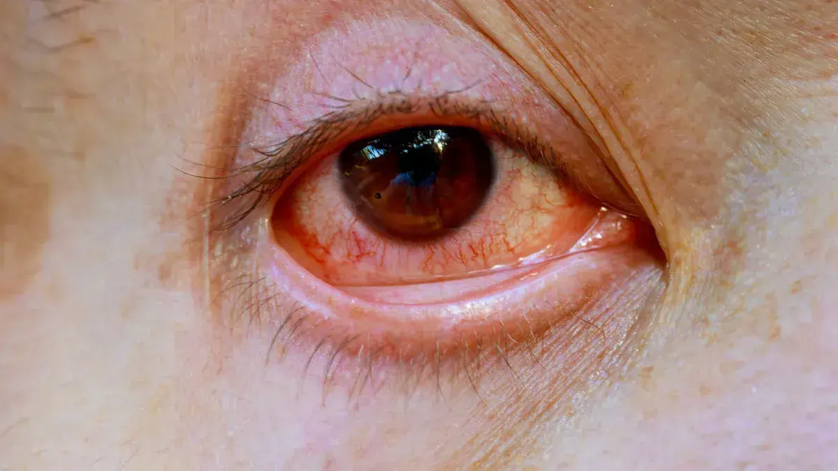 El síntoma de glucosa alta que se manifiesta en los ojos
