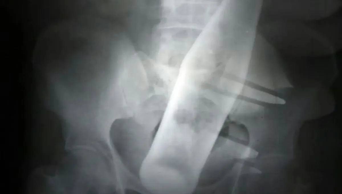 Le dijo a su esposa que tenía dolor de panza, pero los médicos descubrieron una botella en su recto