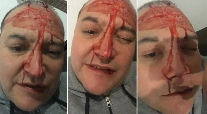 Onicofagia: cuáles son los peligros de morderse las uñas