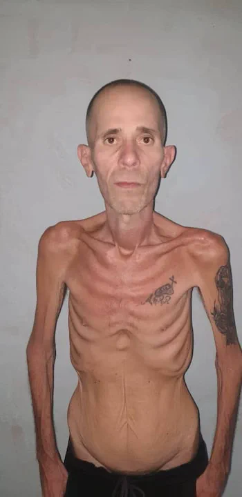Un hombre de torso desnudo y extrema delgadez mirando al frente parado ante una pared clara.