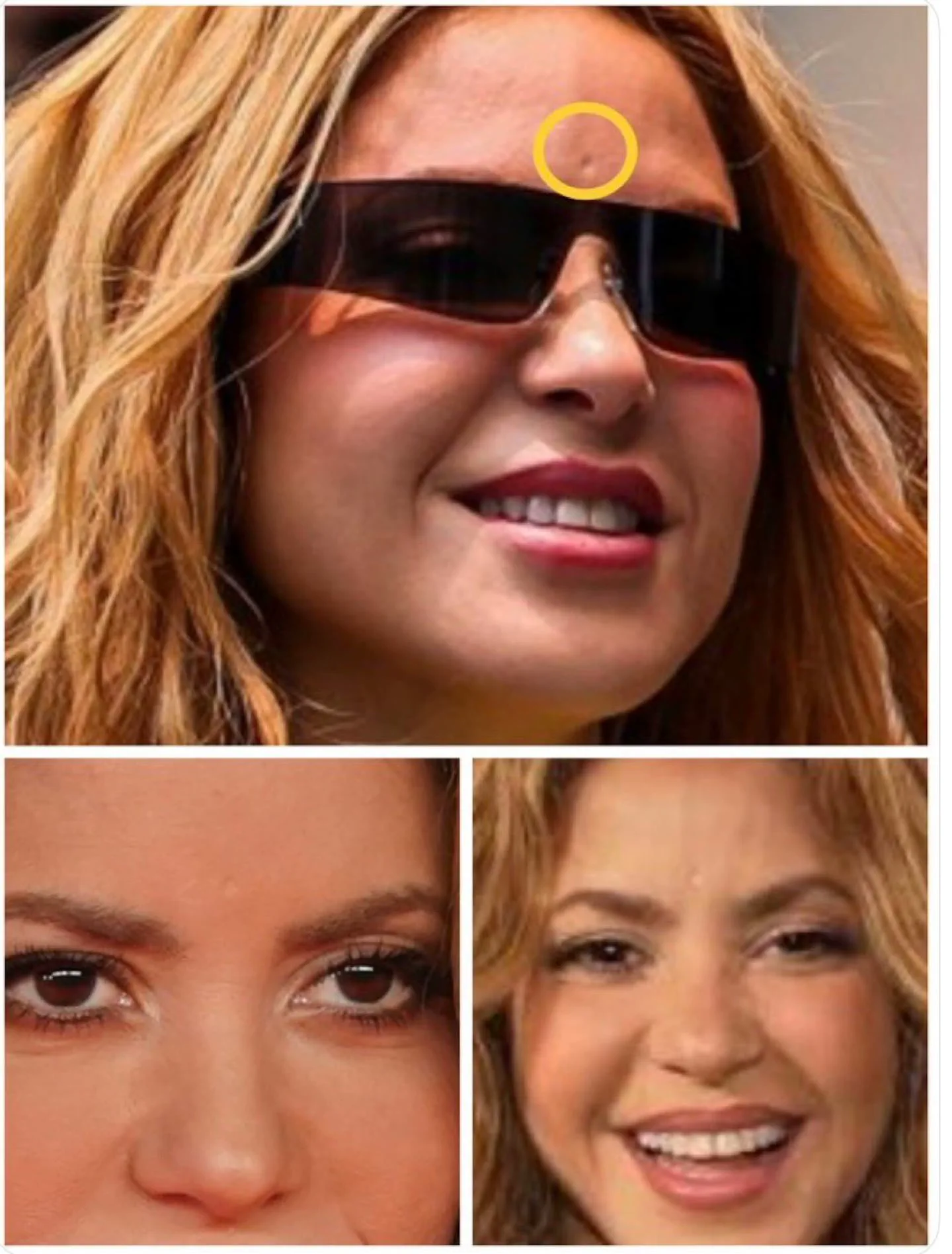 Primeros planos del rostro de la cantante Shakira con un círculo amarillo que señala una marca en su frente.