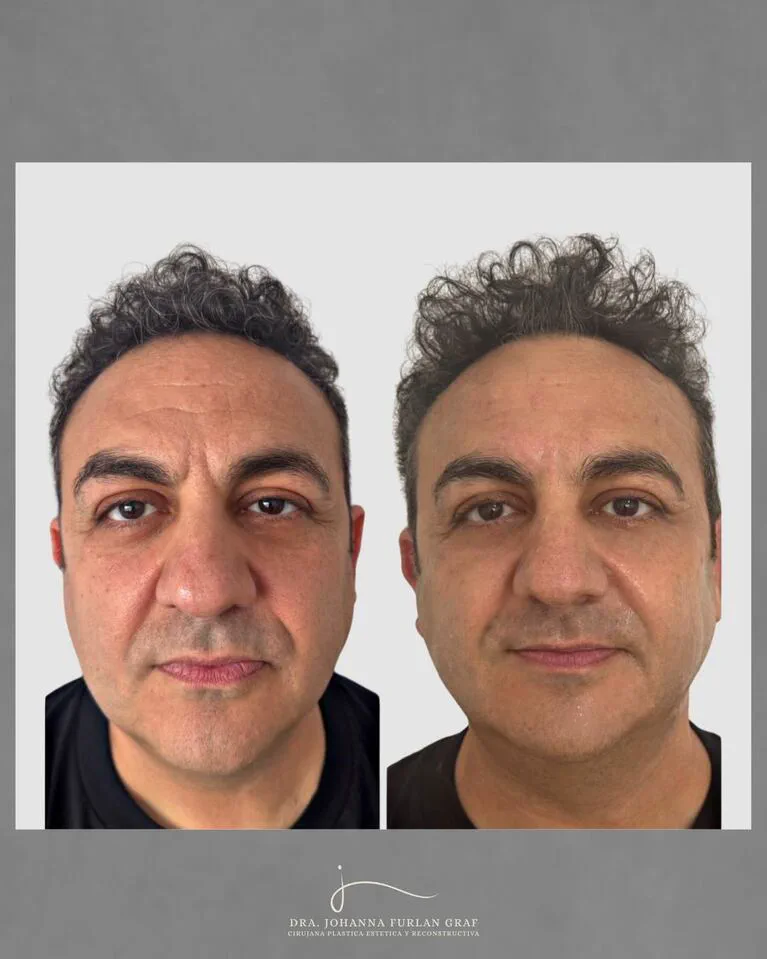 Comparacion de rostro en primer plano de un hombre con pelo enrulado antes y despues de un tratamiento.