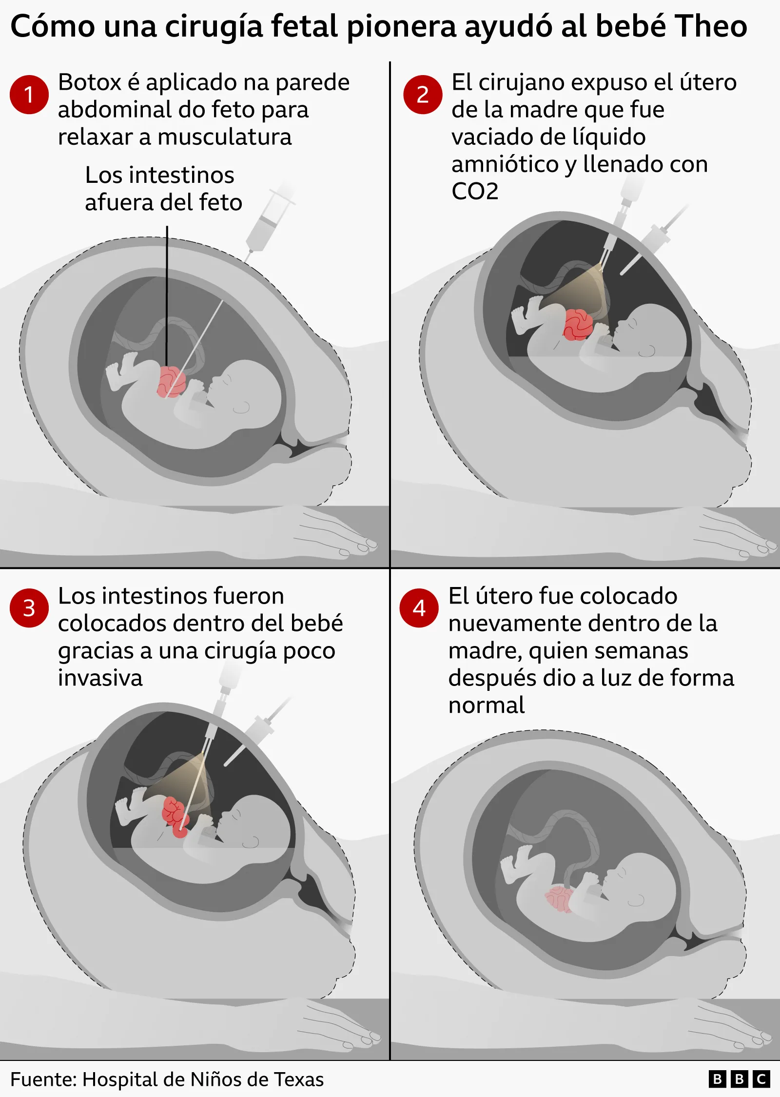 Infografía explicativa en cuatro pasos ilustrados sobre un procedimiento de cirugía fetal.