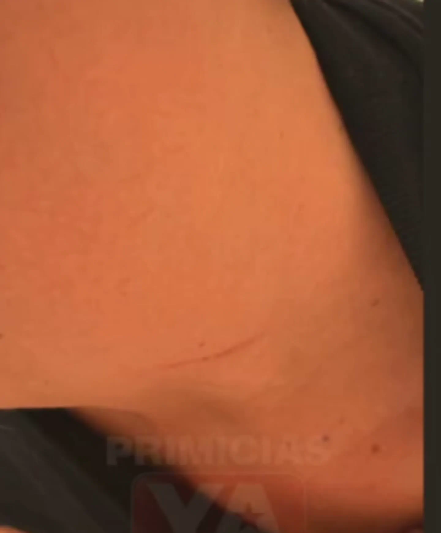 Primer plano de la piel en una zona del cuerpo donde se observa un pequeno rasguno lineal.