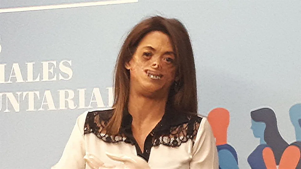 Una mujer con marcas de quemaduras en la cara viste una camisa blanca con encaje frente a un fondo celeste.