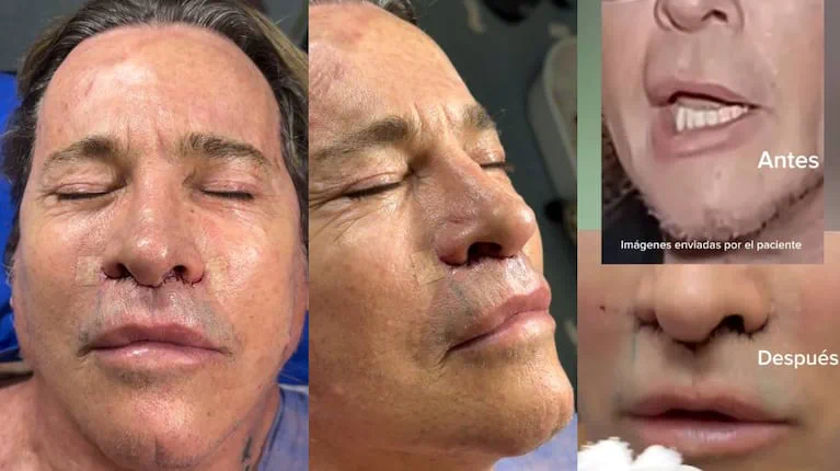 Guido Süller con los ojos cerrados mostrando suturas e incisiones quirúrgicas debajo de la nariz.