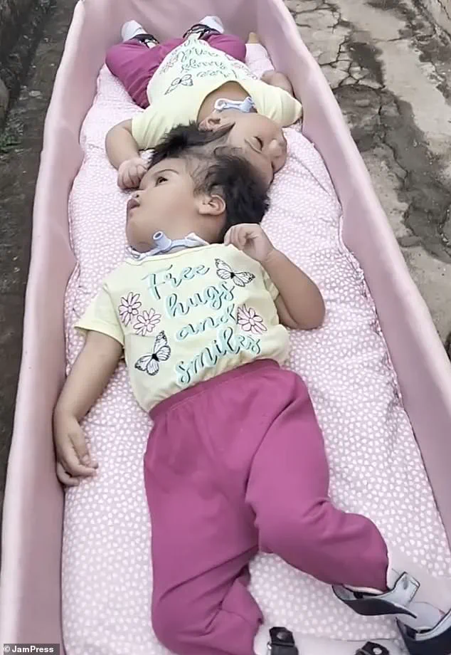 Dos bebés siamesas unidas por la cabeza recostadas boca arriba sobre una colchoneta rosa.