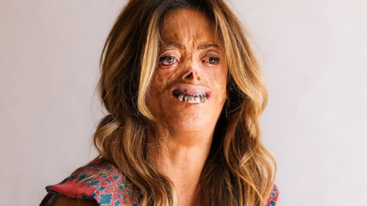 Primer plano de una mujer de cabello castaño con cicatrices en el rostro sobre fondo claro.