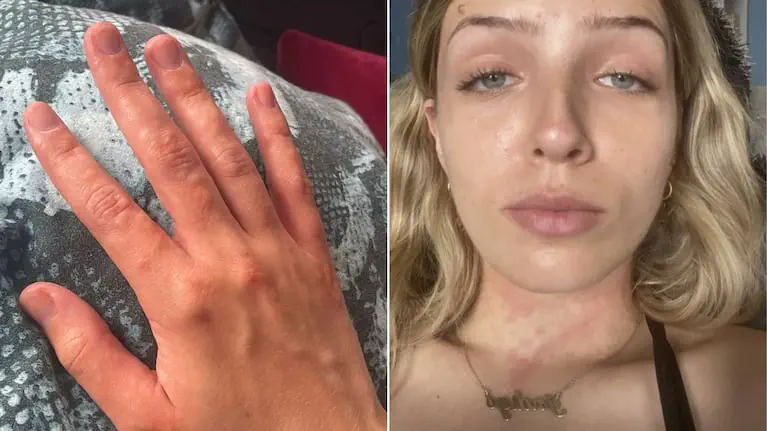 Composición que muestra una mano enrojecida y el rostro de una mujer rubia con manchas rojizas en el cuello.