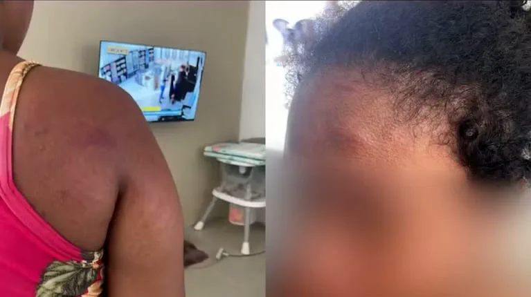 Una mujer y un nene muestran marcas y moretones en su piel frente a un televisor.