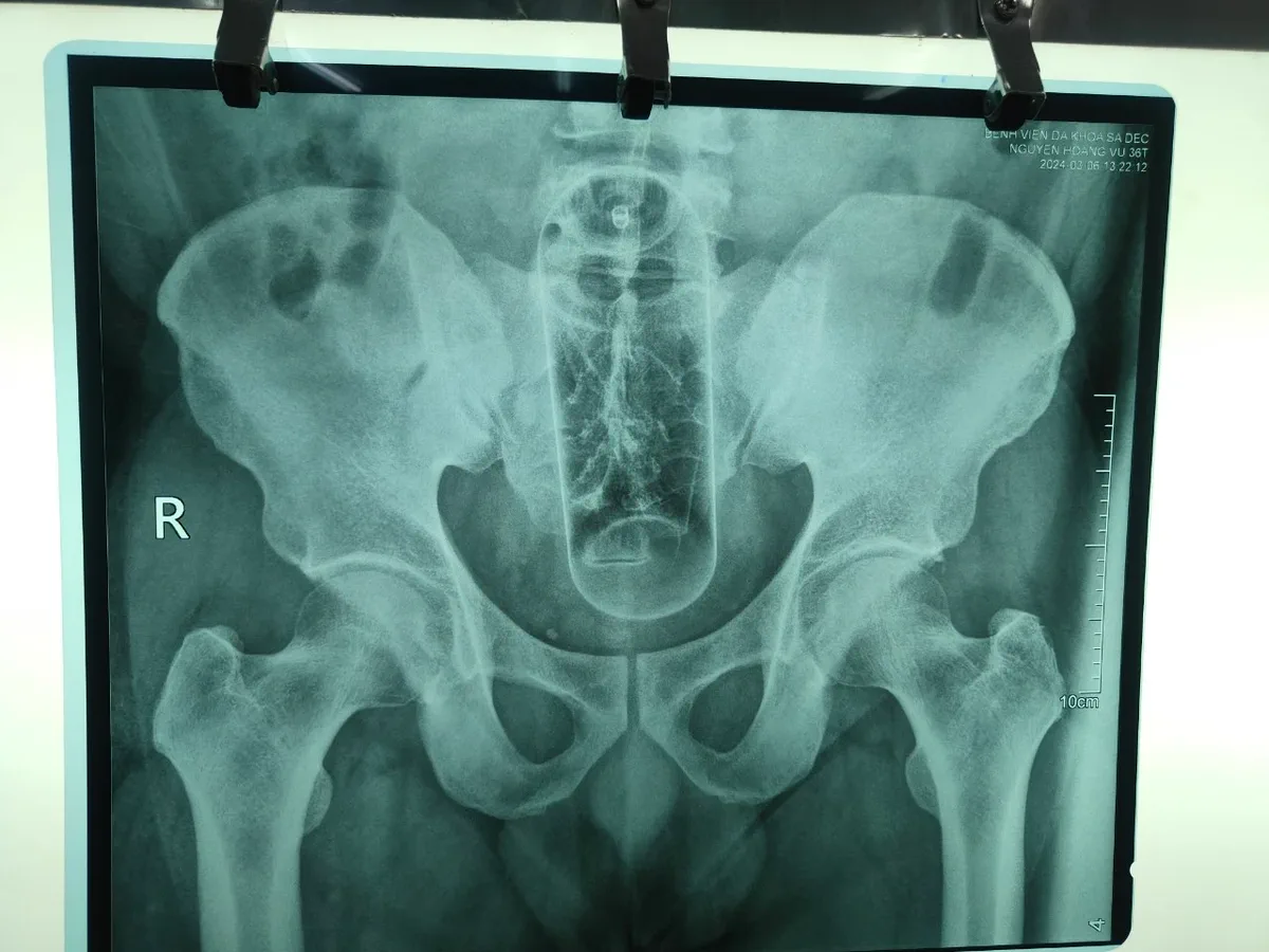 Le dijo a su esposa que tenía dolor de panza, pero los médicos descubrieron una botella en su recto