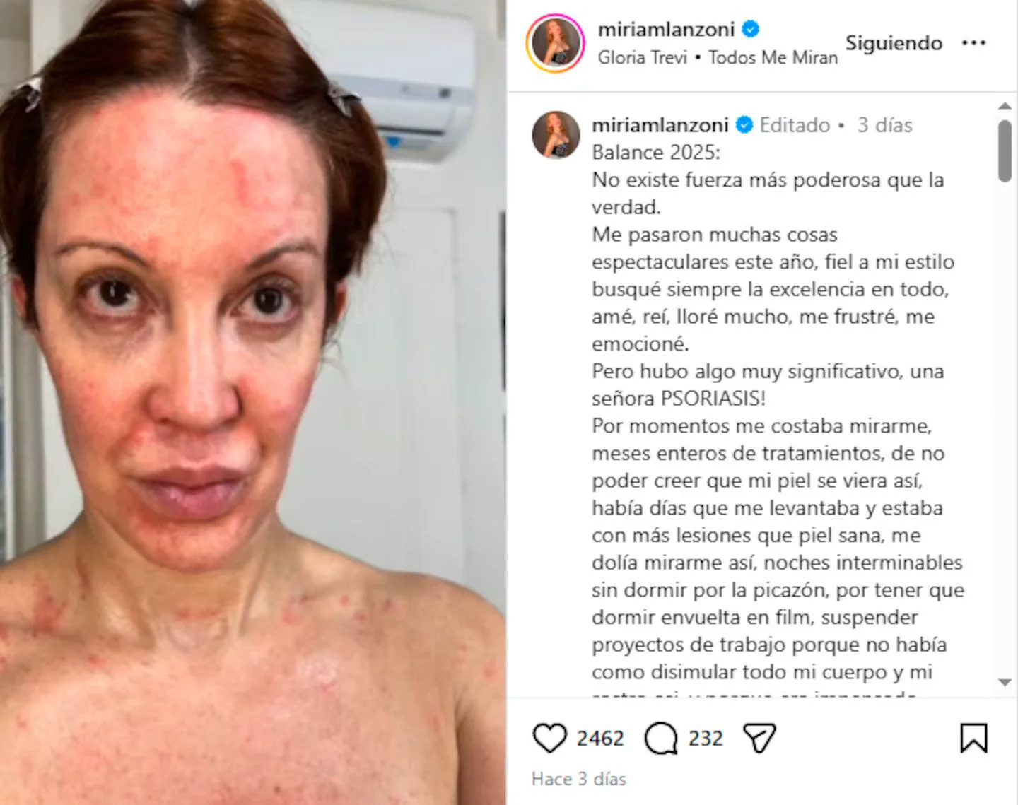Miriam Lanzoni habló del duro momento que atraviesa por una enfermedad autoinmune