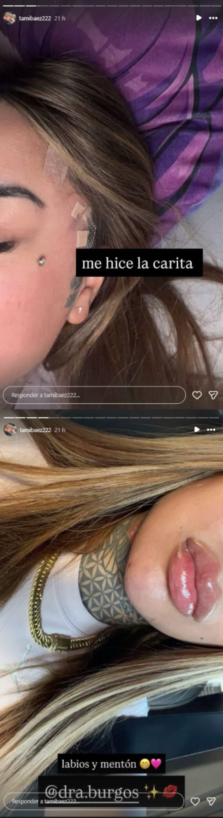 Tamara Baez muestra en historias de Instagram su rostro con parches cerca de la oreja y sus labios retocados.