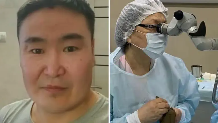 Los especialistas realizaron un examen y encontraron la causa: una semilla había germinado dentro del ojo, desarrollando una raíz de casi 3 milímetros que penetraba la conjuntiva, la membrana que recubre la parte blanca del ojo.