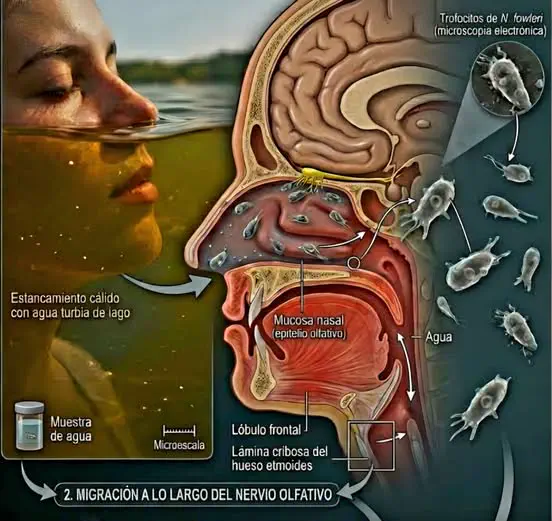 Menigoencefalitis Amebiana primaria:   Información sanitaria y recomendaciones preventivas