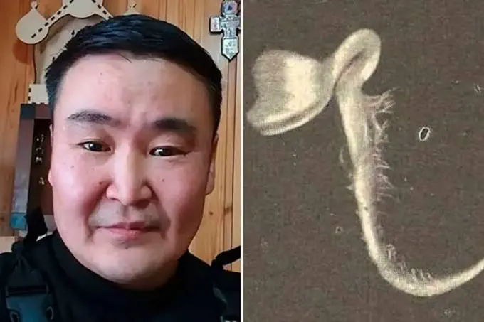 Sufría terribles dolores de cabeza: descubrieron que tenía algo insólito creciendo en el ojo